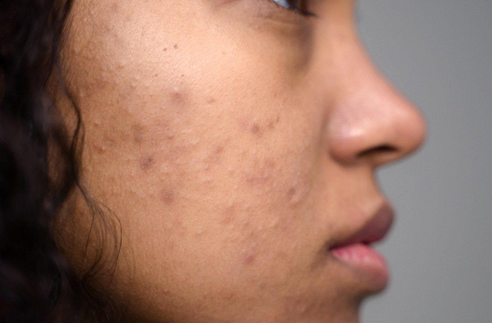 Skin Cancer clinical file review